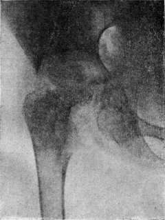 Tuberculosis: figure 11 from the 1928–1936 encyclopedia article