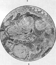 Tuberculosis: figure 8 from the 1928–1936 encyclopedia article