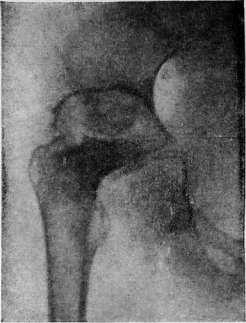 Tuberculosis: figure 12 from the 1928–1936 encyclopedia article