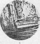 Myeloma: figure 1 from the 1928–1936 encyclopedia article