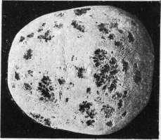 Myeloma: figure 2 from the 1928–1936 encyclopedia article