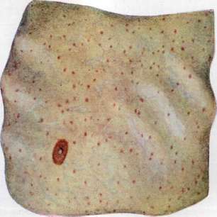 Typhus (TYPHUS): figure 12 from the 1928–1936 encyclopedia article