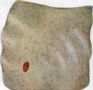Typhus (TYPHUS): figure 11 from the 1928–1936 encyclopedia article
