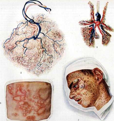 Urticaria: figure 3 from the 1928–1936 encyclopedia article