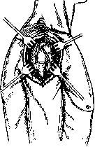 Dislocations: figure 4 from the 1928–1936 encyclopedia article