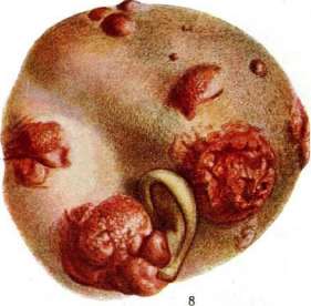 Soft Chancre: figure 7 from the 1928–1936 encyclopedia article