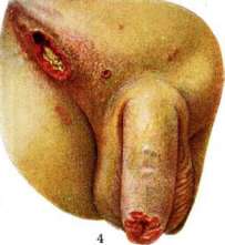 Soft Chancre: figure 2 from the 1928–1936 encyclopedia article