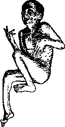 Athetosis: figure 2 from the 1928–1936 encyclopedia article