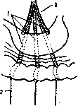 Gastroplication: figure 1 from the 1928–1936 encyclopedia article