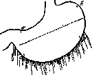 Gastroplication: figure 2 from the 1928–1936 encyclopedia article