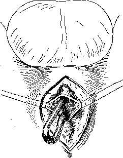 Urethra: figure 12 from the 1928–1936 encyclopedia article