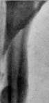Pubic Symphysis: figure 4 from the 1928–1936 encyclopedia article