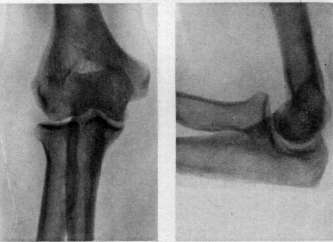 Pubic Symphysis: figure 2 from the 1928–1936 encyclopedia article