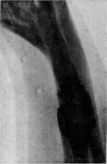 Pubic Symphysis: figure 3 from the 1928–1936 encyclopedia article