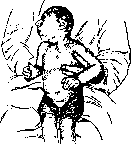 Microcephaly: figure 1 from the 1928–1936 encyclopedia article