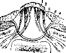 Spina Bifida: figure 3 from the 1928–1936 encyclopedia article