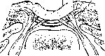 Spina Bifida: figure 2 from the 1928–1936 encyclopedia article