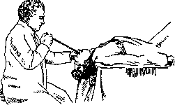 Esophagoscopy: figure 11 from the 1928–1936 encyclopedia article