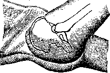 Roseola: figure 1 from the 1928–1936 encyclopedia article