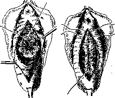 Colpopoiesis: figure 3 from the 1928–1936 encyclopedia article