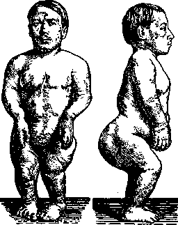 Achondroplasia: figure 1 from the 1928–1936 encyclopedia article