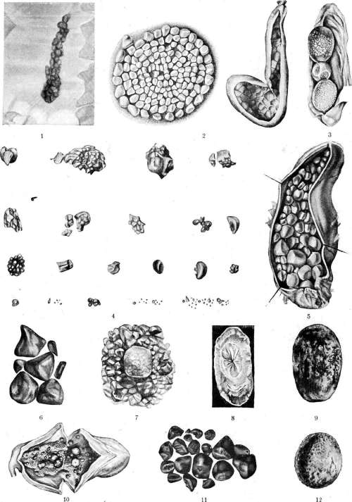 Cholelithiasis: figure 1 from the 1928–1936 encyclopedia article