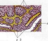 Hypernephritis: figure 2 from the 1928–1936 encyclopedia article