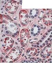 Hypernephritis: figure 4 from the 1928–1936 encyclopedia article