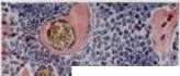 Hypernephritis: figure 5 from the 1928–1936 encyclopedia article