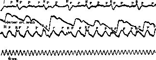 Atrial Fibrillation: figure 5 from the 1928–1936 encyclopedia article