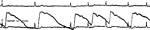 Atrial Fibrillation: figure 2 from the 1928–1936 encyclopedia article