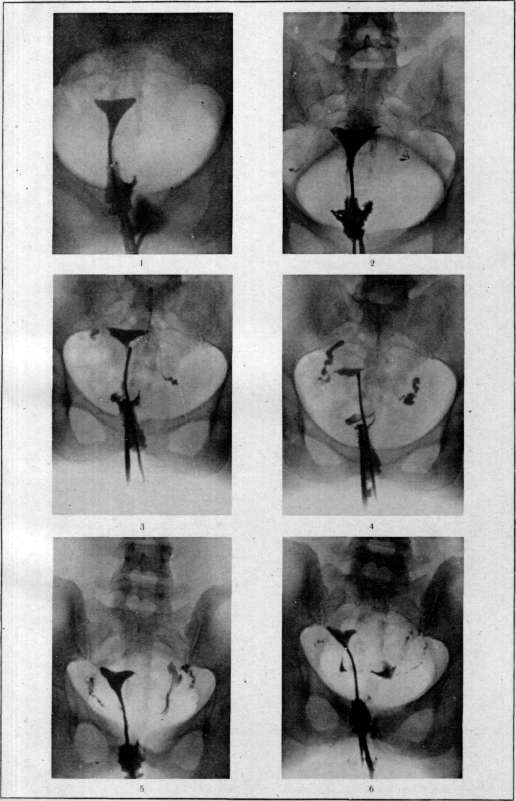 Hysterosalpingography: figure 7 from the 1928–1936 encyclopedia article