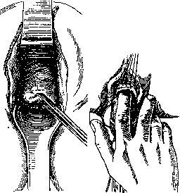 Colpotomy: figure 1 from the 1928–1936 encyclopedia article