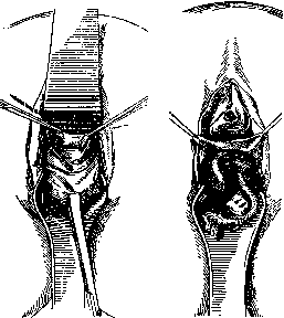Colpotomy: figure 2 from the 1928–1936 encyclopedia article