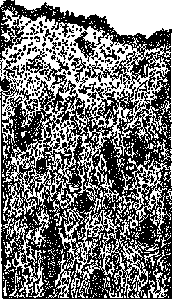 Abscess: figure 2 from the 1928–1936 encyclopedia article