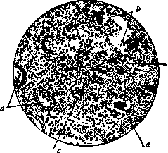 Abscess: figure 1 from the 1928–1936 encyclopedia article