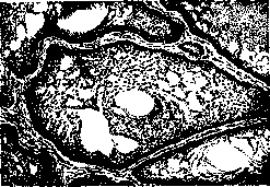 Adamantinoma: figure 2 from the 1928–1936 encyclopedia article