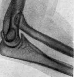 Uterine Inversion: figure 2 from the 1928–1936 encyclopedia article