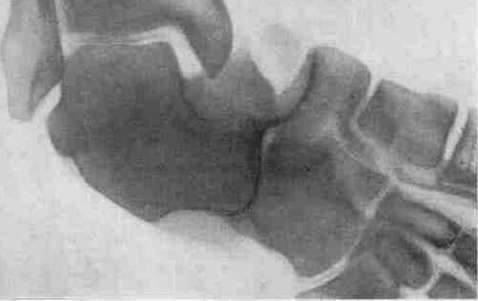 Uterine Inversion: figure 5 from the 1928–1936 encyclopedia article
