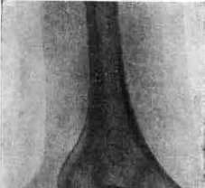 Uterine Inversion: figure 3 from the 1928–1936 encyclopedia article