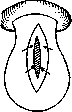 Uterine Inversion: figure 8 from the 1928–1936 encyclopedia article