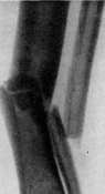 Fractures: figure 9 from the 1928–1936 encyclopedia article