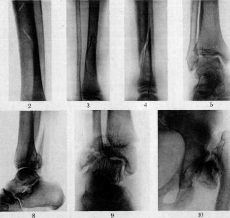 Fractures: figure 11 from the 1928–1936 encyclopedia article