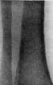 Fractures: figure 12 from the 1928–1936 encyclopedia article