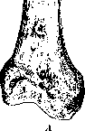 Fractures: figure 1 from the 1928–1936 encyclopedia article