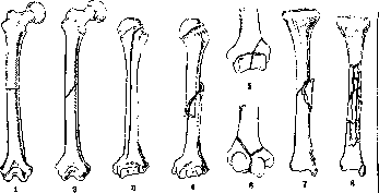 Fractures: figure 3 from the 1928–1936 encyclopedia article