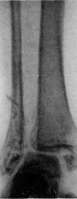 Fractures: figure 10 from the 1928–1936 encyclopedia article