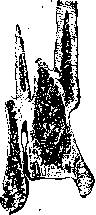 Fractures: figure 15 from the 1928–1936 encyclopedia article
