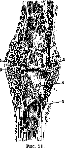 Fractures: figure 14 from the 1928–1936 encyclopedia article