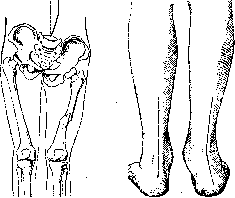 Fractures: figure 20 from the 1928–1936 encyclopedia article